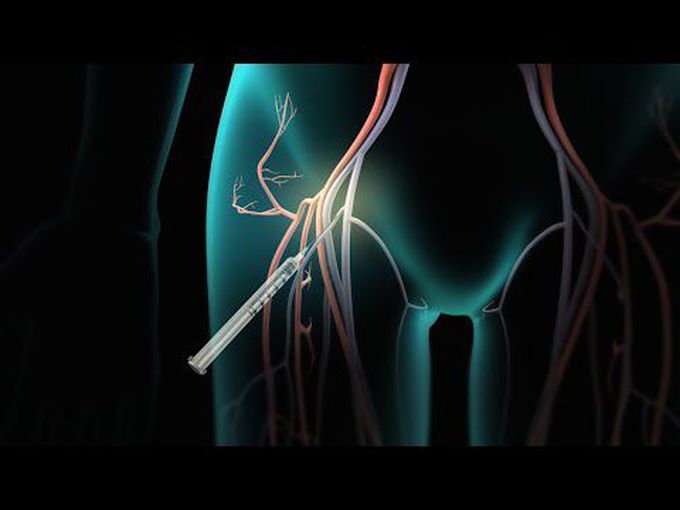 Catheter Ablation-3D animation