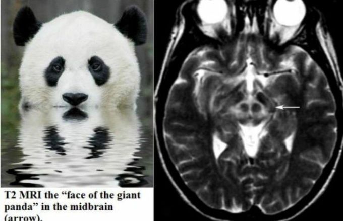 Wilson's disease 🐼