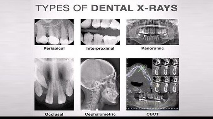 Types of intraoral radiographs