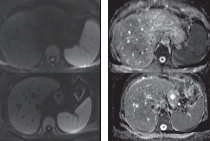 Fig 52-year-old man with chronic hepatitis C