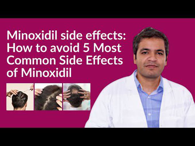 Minoxidil-Side effects and solutions