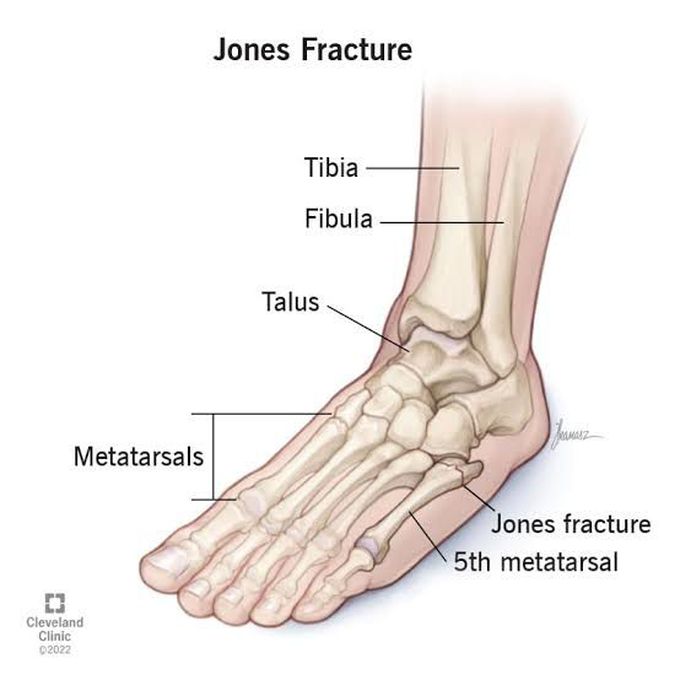 Jones fracture