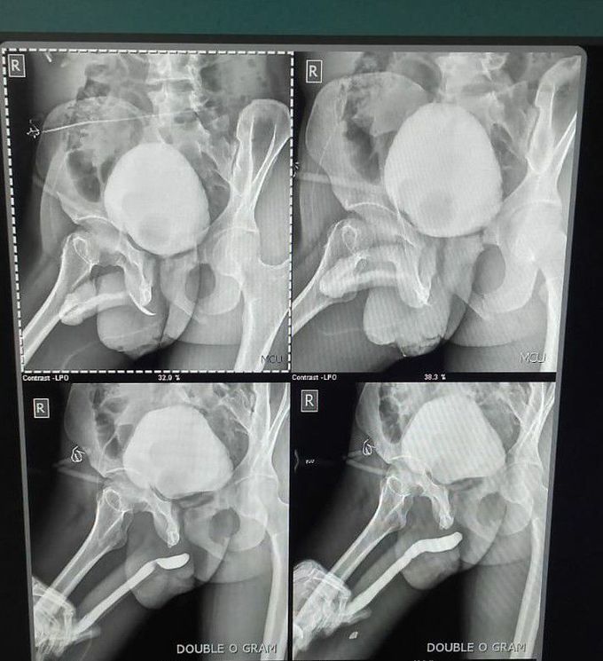 Urethral trauma