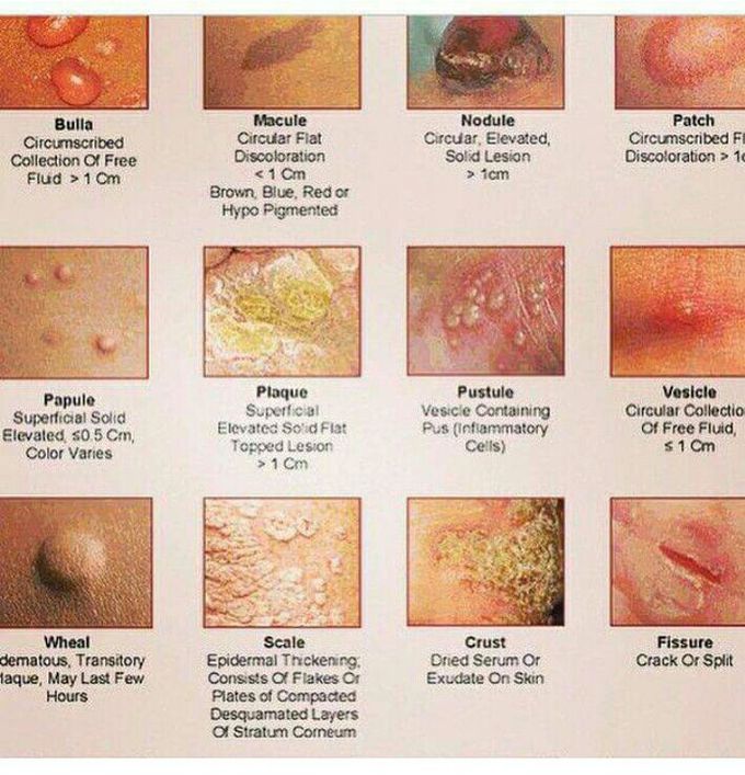Skin lesion