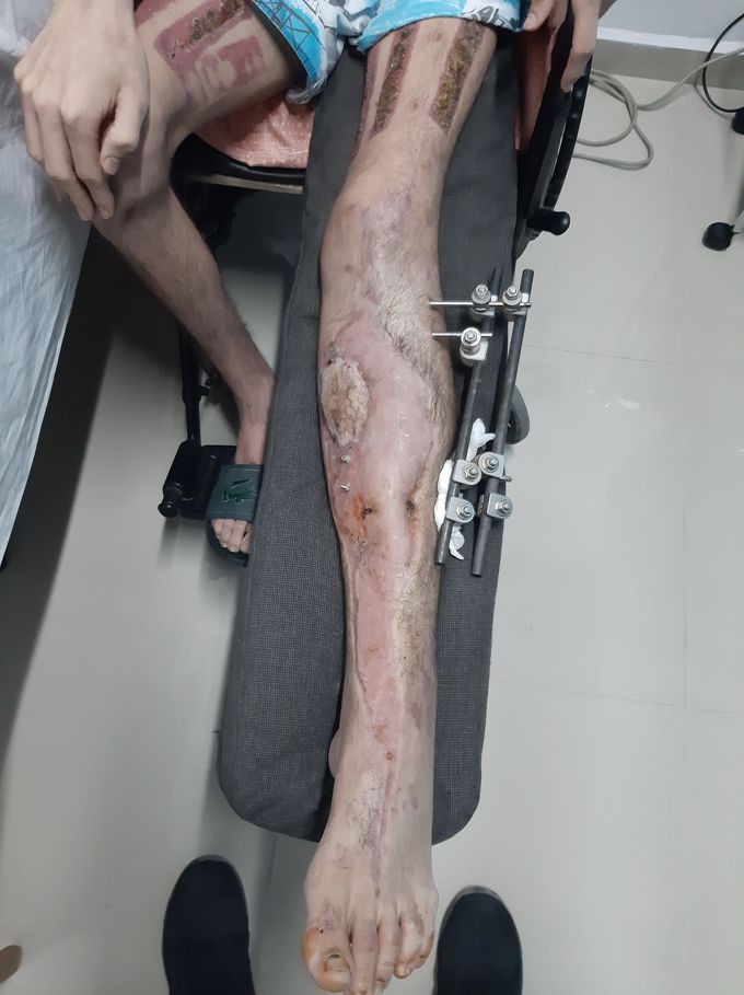 Fisioterapia