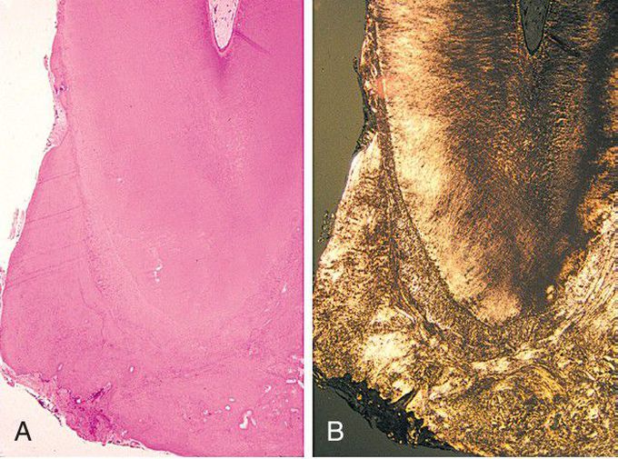 Hypercementosis