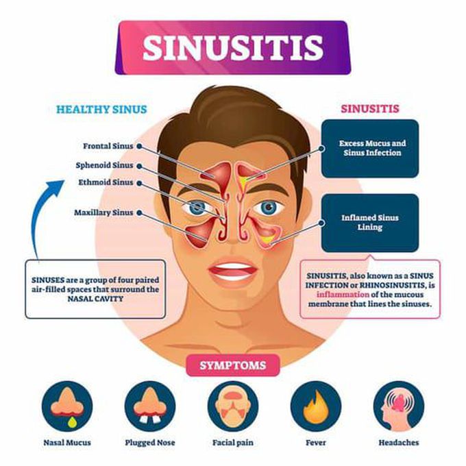 Symptoms of Sinuses