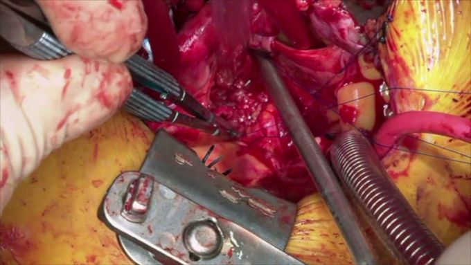 Aortic and Mitral Valve Replacements through J-type Partial Sternotomy
