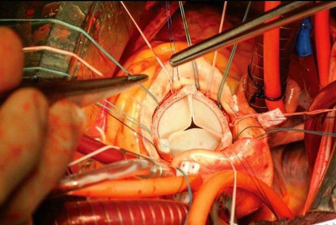 Aortic valve replacement