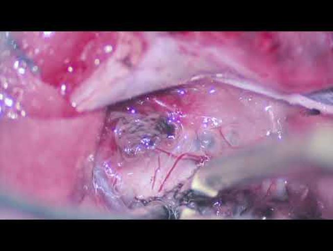 Microsurgical resection of a large  cavernous malformation of the medulla oblongata