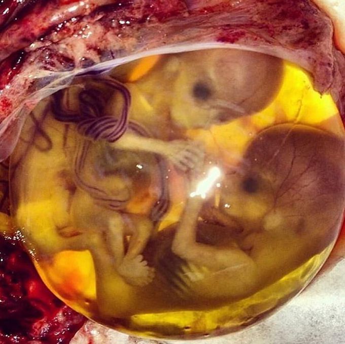 Here is an interesting case of a 12 weeks gestational age ectopic twin pregnancy. 
