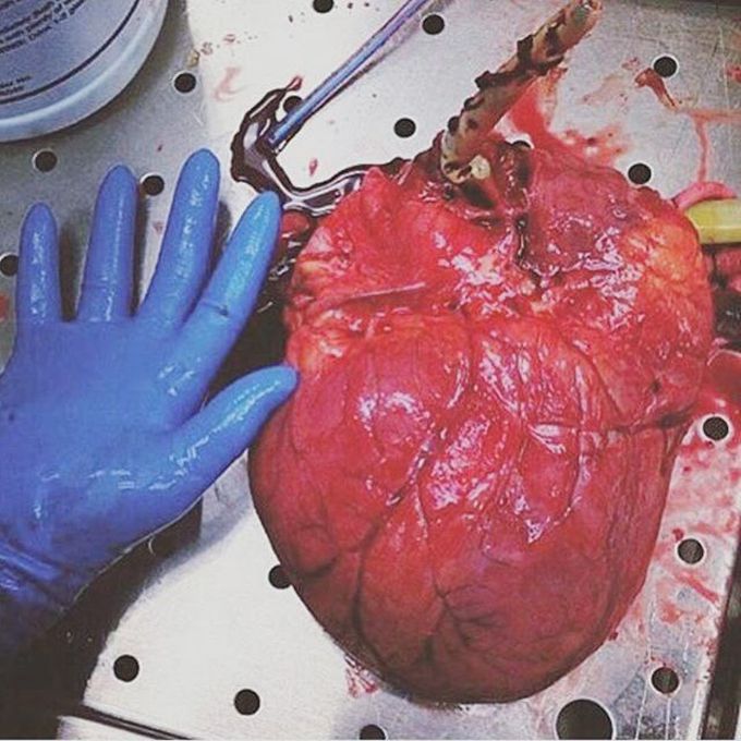 Cardiomegaly