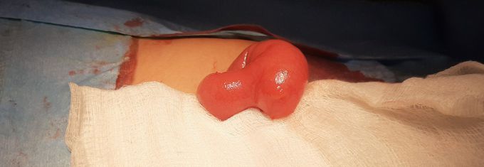 Meckel's diverticulum