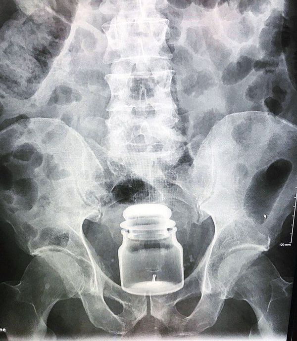 Candle lodged in rectum