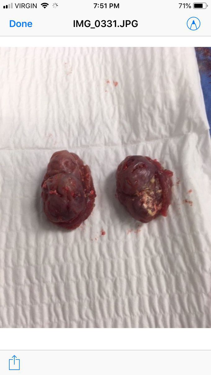 Massive tonsils