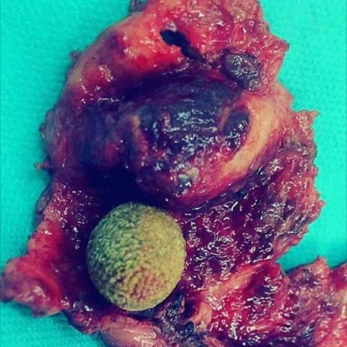 Gallbladder Stone, a huge one, this probably kept forming for years