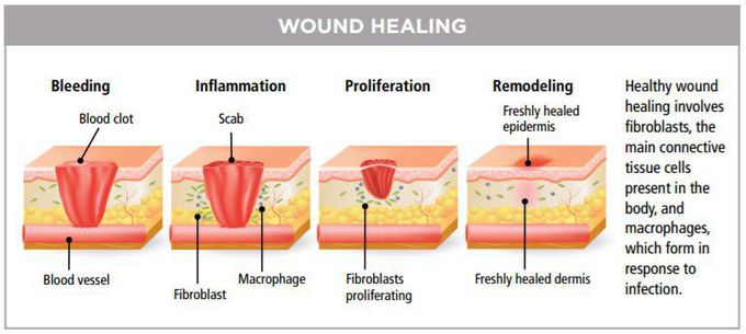 Stages of Wound Healing