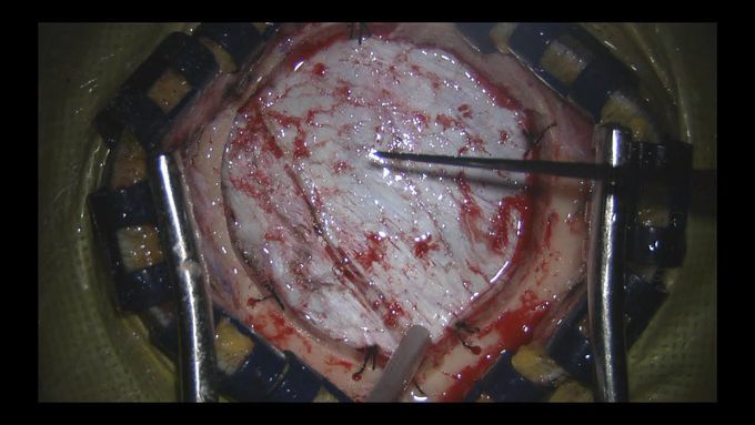 Brain Cryptic Aretriovenous Malformation (AVM).  Surgical treatment.