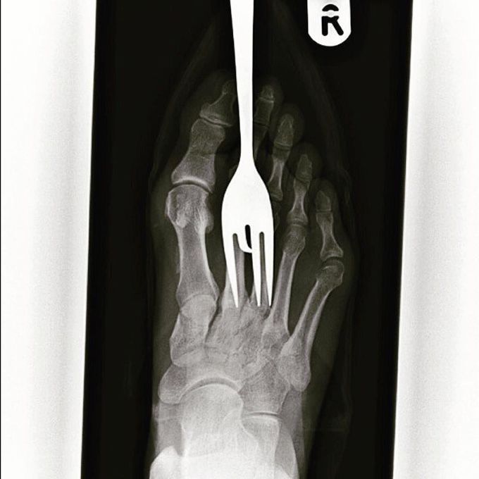 Foot fork-stabbing injury, better watch your steps!