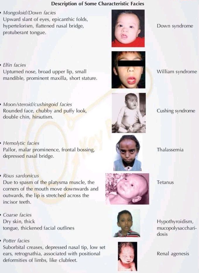 various FACIES &their SYNDROMES