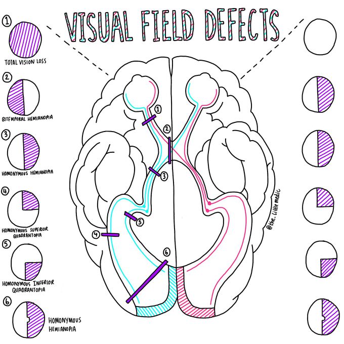 Visual field defects