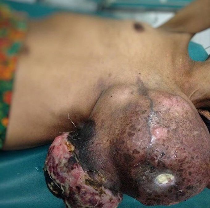 Breast cancer!