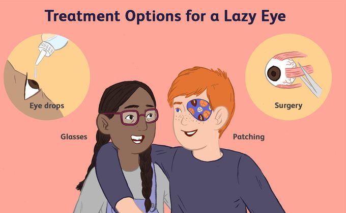 Treatment for Amblyopia