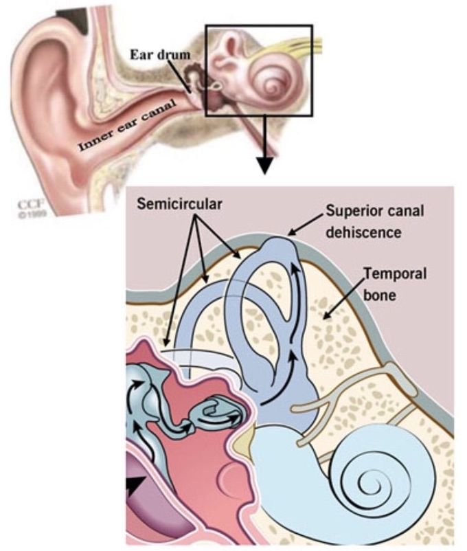 Superior canal dehiscence syndrome