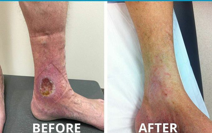 BEFORE and AFTER VENOUS ULCER