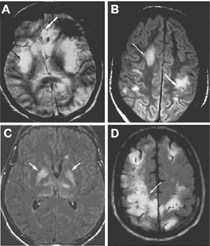 Cognitive and Physical Symptoms of Ascites