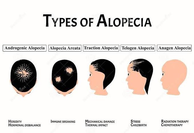 Types of alopecia