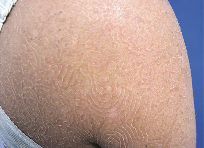 Tinea Imbricata