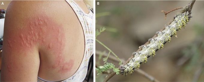Erucism Due to Lepidoptera Caterpillar Envenomation