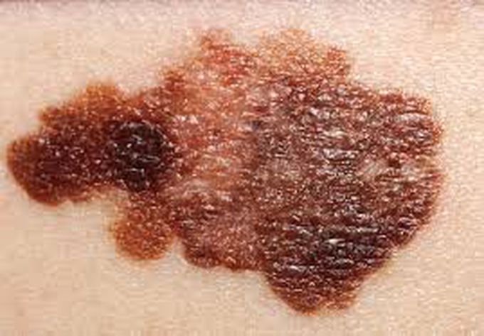 Stages of melanoma