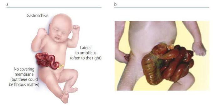 Gastroschisis