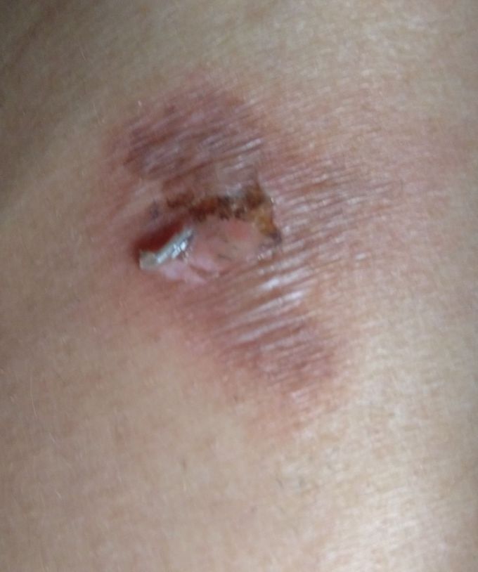 Burn on leg