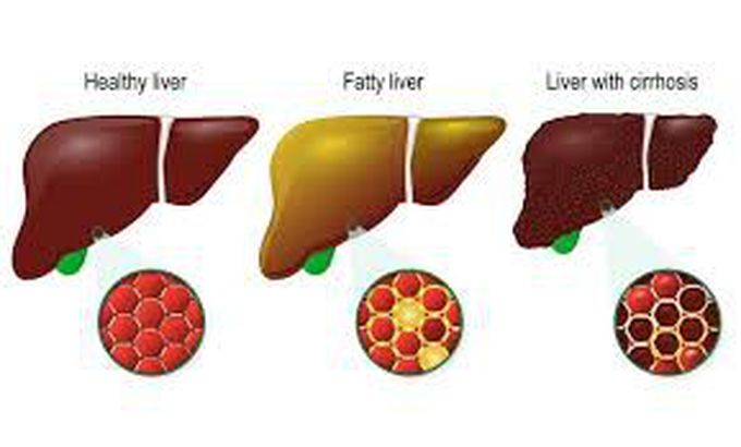 No to alcohol protect your liver,most of the male patients - MEDizzy