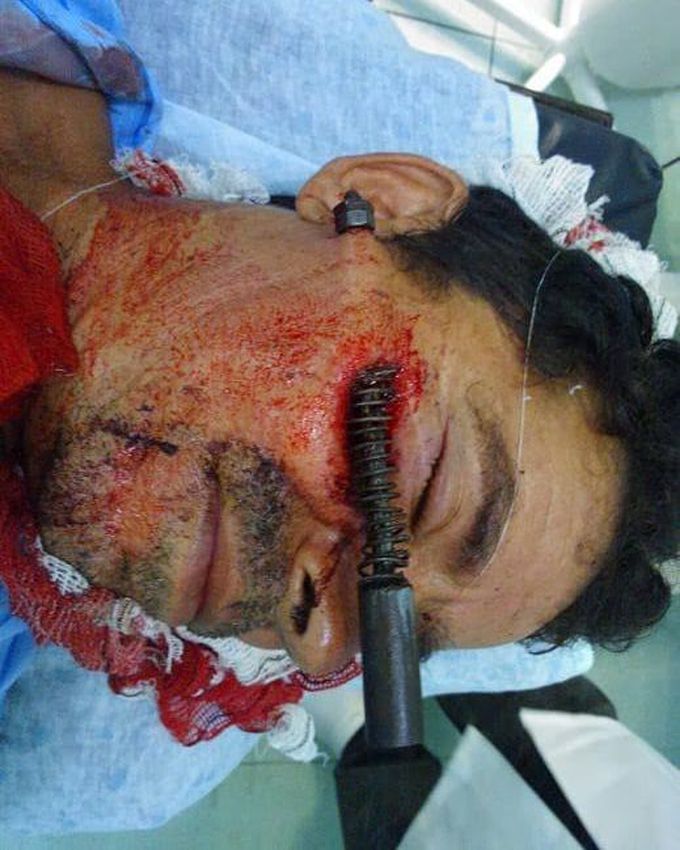 Firearm accident! 