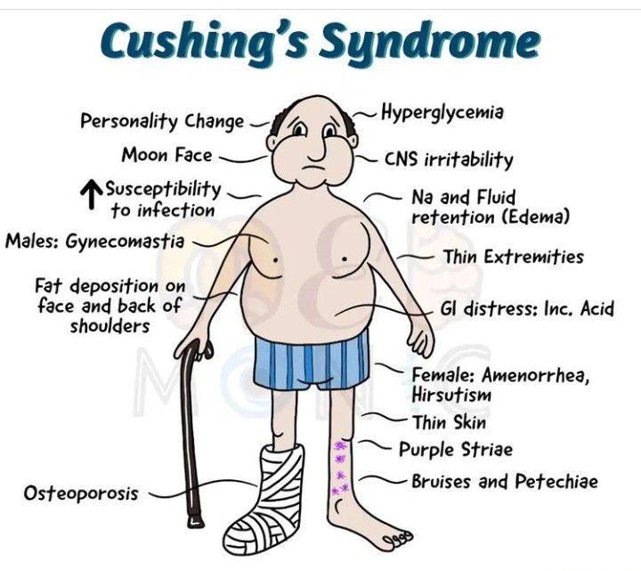 Cushing Syndrome Medizzy 