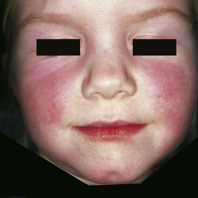 Erythema Infectiosum | Fifth Disease