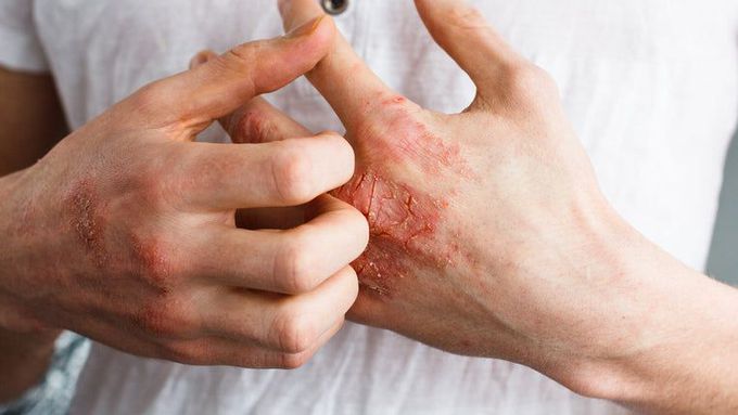 Eczema