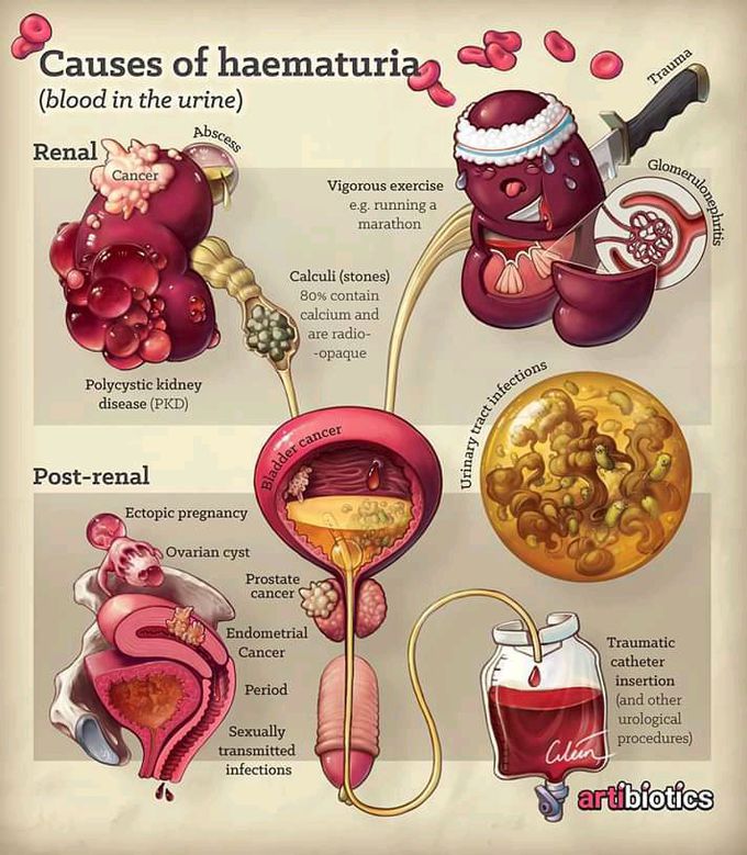 Causes of heamaturia