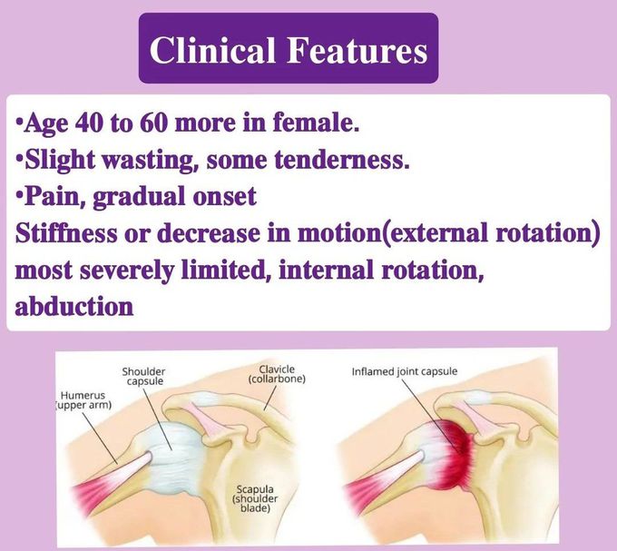Clinical Features of Frozen Shoulder