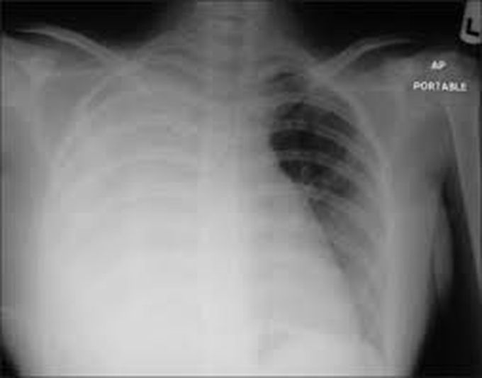 left hemothorax x ray