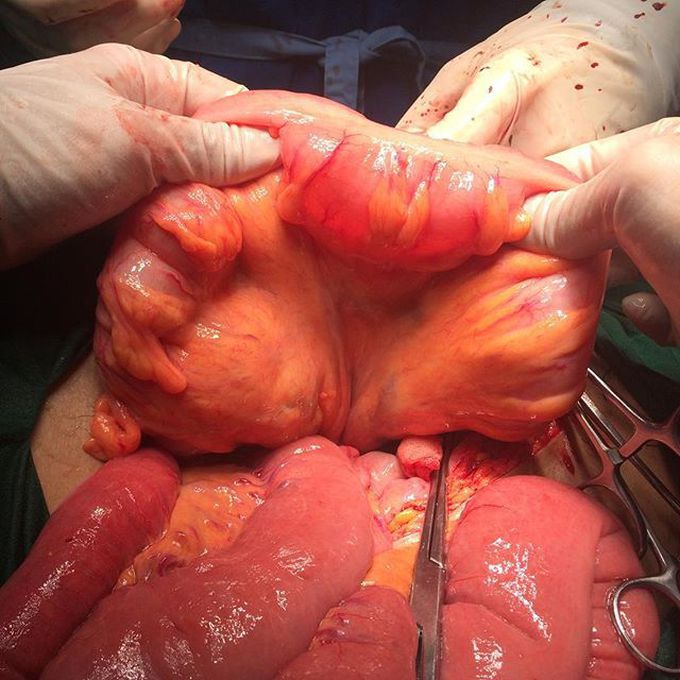 Sigmoid colon...