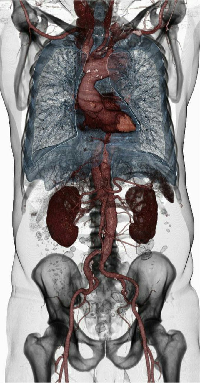 CT Scan
