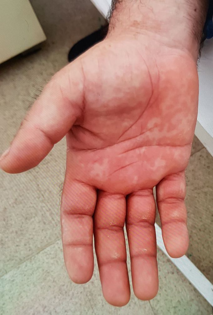 Adult Still disease- how treat?