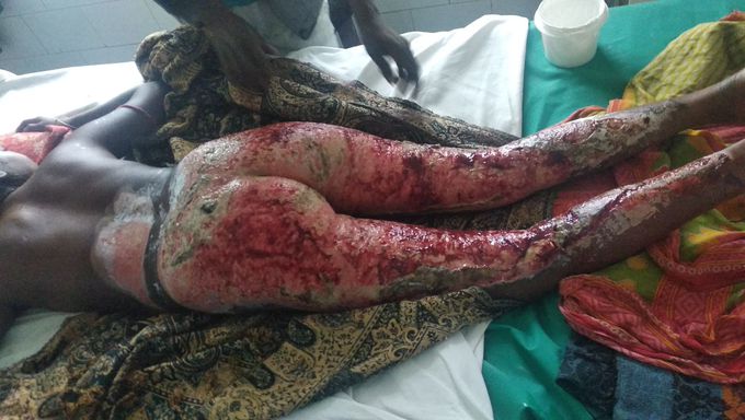 Burn case in Dr sushila tiwari govt hospital haldwani.(Nanital)