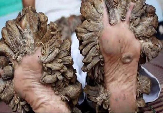 Epidermodysplasia verruciformis
