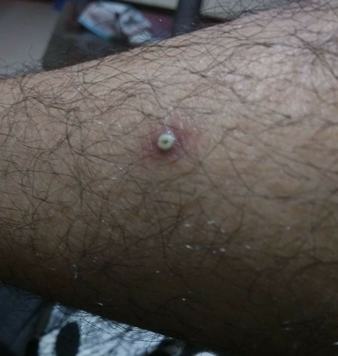Pus filled painful localized swelling in leg